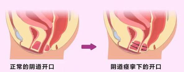 阴道痉挛该怎么训练放松-示意图