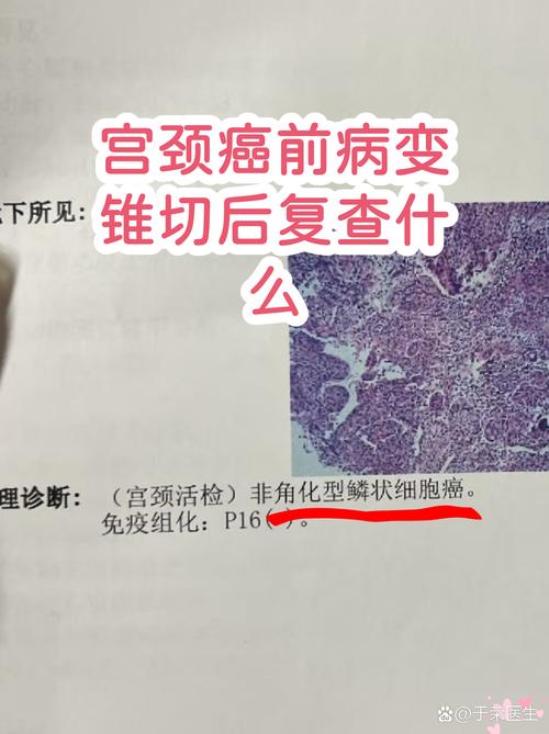 宫颈病变复查要查哪些项目