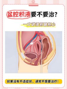 盆腔积液要不要抽液,多数情况根本不用折腾-两性知识丨两性健康--你想了解的我都知道