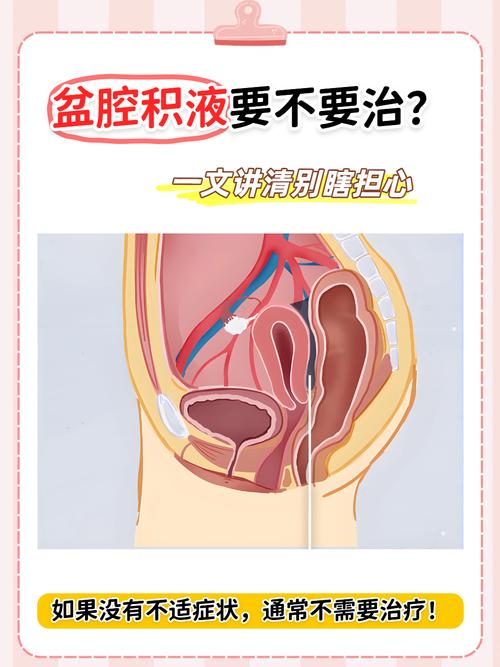 盆腔积液要不要抽液-相关配图