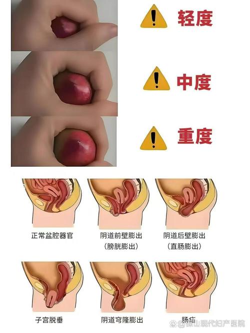 子宫脱垂轻度和重度怎么分