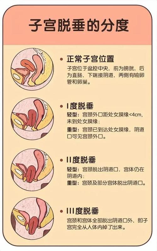 子宫脱垂轻度和重度怎么分