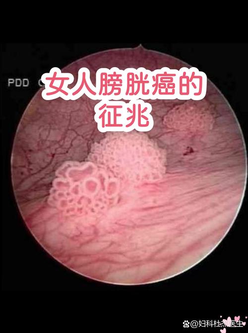 膀胱癌早期有什么表现