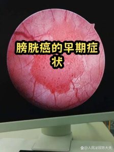 膀胱癌早期有什么表现？这5个信号别当成小毛病-两性知识丨两性健康--你想了解的我都知道