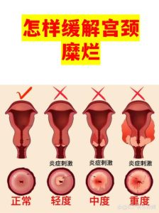 体检单上的“宫颈糜烂”，多数情况真不用急着治-两性知识丨两性健康--你想了解的我都知道