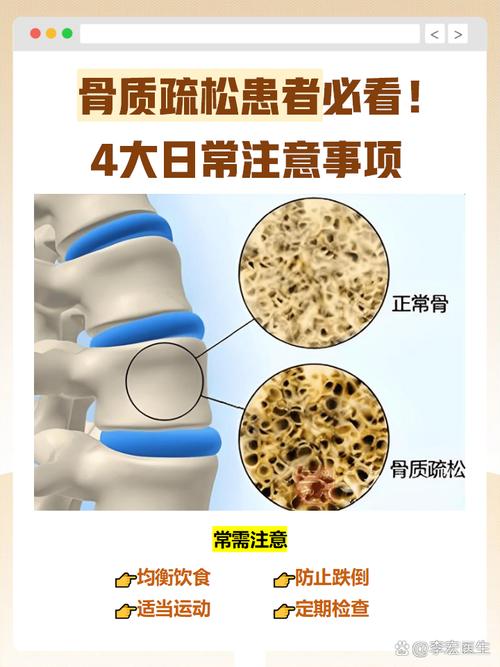 绝经后骨质疏松怎么防-示意图