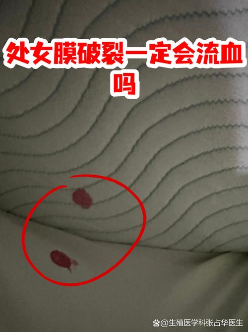 处女膜破裂一定会出血吗