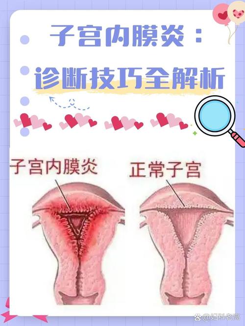 性欲低和子宫内膜炎有关吗-相关配图