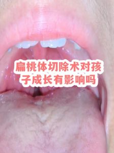 扁桃体切除后性欲下降?别急着怪手术-两性知识丨两性健康--你想了解的我都知道