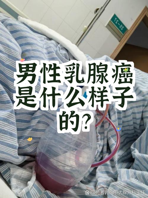 男性乳房肿块要排查什么