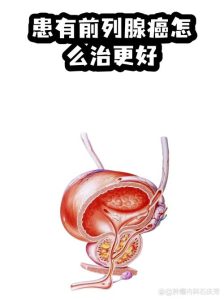 前列腺癌治疗后性欲下降,其实是可干预的副作用-两性知识丨两性健康--你想了解的我都知道