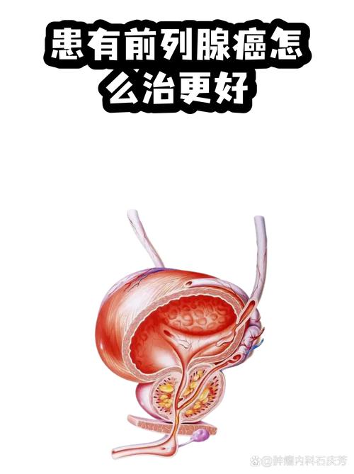 性欲低和前列腺癌治疗有关吗-相关配图